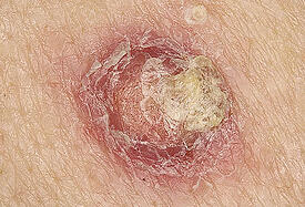 squamous cell 